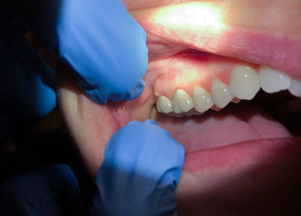 Best Broken Tooth Emergency  in Montrose, CO